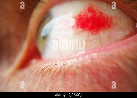 Subkonjunktivale Blutung - Hyposphagma. Nahaufnahme eines roten, blutunterlaufenen Auges. Auge mit platzten Blutgefäßen aus der Nähe Stockfoto