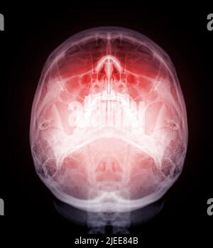 Schädel Röntgenbild des menschlichen Schädels Wasseransicht isoliert auf schwarzem Hintergrund. Stockfoto