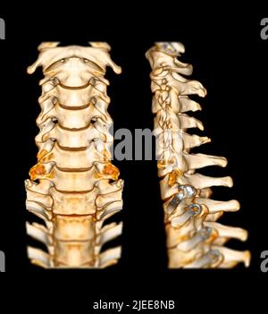 CT-SCAN der Halswirbelsäule ( C-Wirbelsäule ) Patienten Trauma Fall 3D Rendering Bild . Medizintechnikkonzept. Stockfoto