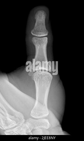 X-Raiy-Bild des Daumenfingers. Stockfoto