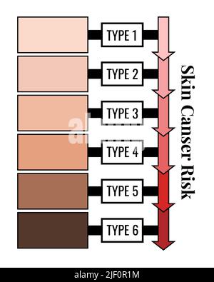 Fitzpatrick Hautphototypenskala mit Abhängigkeit vom Krebsrisiko. Stock Vektor