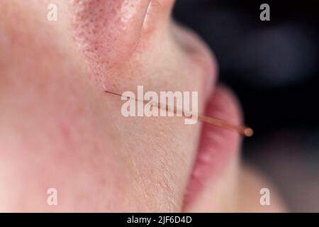 Ein Porträt einer kleinen Akupunkturnadel, die in das Gesicht einer Person neben der Nase klebt, um Schmerzen zu heilen, Stress zu lindern oder einen anderen medizinischen Zustand mit zu lindern Stockfoto