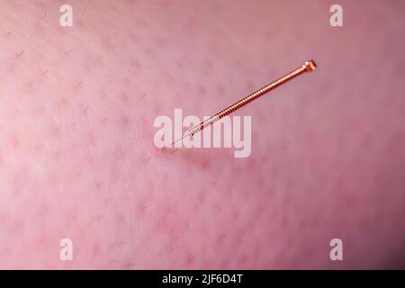 Eine kleine Akupunkturnadel, die in die Haut eines Patienten klebt. Die Nadel hat einen Kupfergriff und wird tief in die Haut punktiert, um Stress und zu lindern Stockfoto