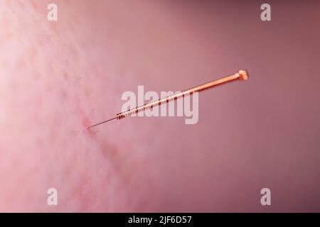 Eine Akupunkturnadel, die in die Haut eines Patienten klebt. Die kleine Nadel hat einen Kupfergriff und wird tief in die Haut punktiert, um Stress und Stress zu lindern Stockfoto