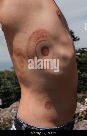 Nahaufnahme der Haut nach traditioneller Schröpfung oder Vakuumtherapie. Bild mit Kopierbereich. Blutergüsse am Körper. Hochwertige Fotos Stockfoto