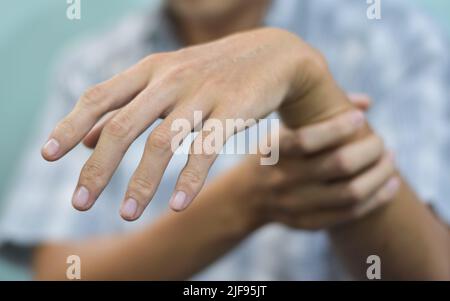 Radiale Nervenverletzung oder Abtropfen des Handgelenks des asiatischen Mannes aus Myanmar. Stockfoto