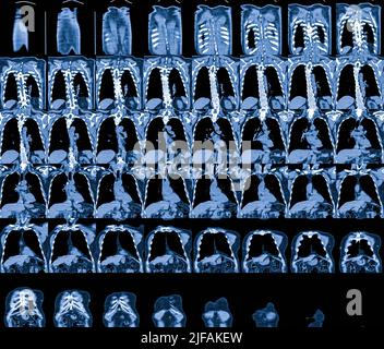 Magnetresonanzbild (MRT) von Brustorganen Stockfoto