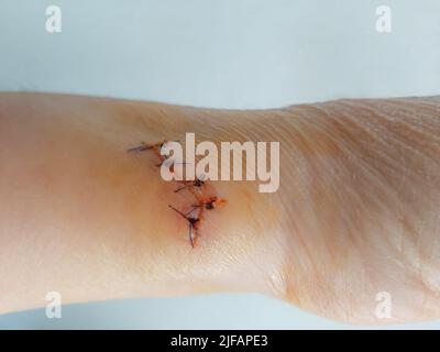 Wunde und Stiche am Arm einer älteren Patientin, Hausunfälle, Altenpflege zu Hause Stockfoto