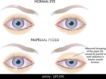 Die medizinische Abbildung zeigt den Vergleich zwischen einem normalen Auge und einem von der Ptosis palpebralis betroffenen Auge. Stock Vektor