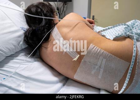 Schwanger mit lumbalem Epiduralkatheter, der aus der epiduralen Verabreichung als Vorbereitung auf die Wehen resultiert Stockfoto
