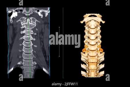 CT-SCAN der Halswirbelsäule ( C-Wirbelsäule ) koronale Ansicht und 3D Rendering-Bildansicht bei Trauma des Patienten . Medizintechnikkonzept. Stockfoto