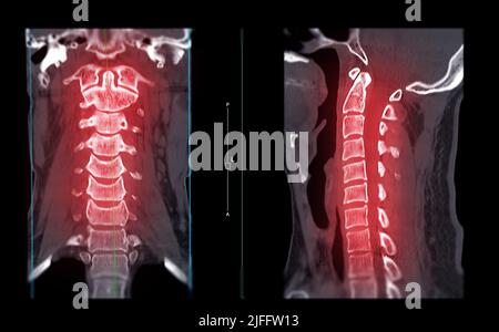 CT-SCAN der Halswirbelsäule ( C-Wirbelsäule ) koronale und sagittale Ansicht bei Traumata des Patienten . Medizintechnikkonzept. Stockfoto