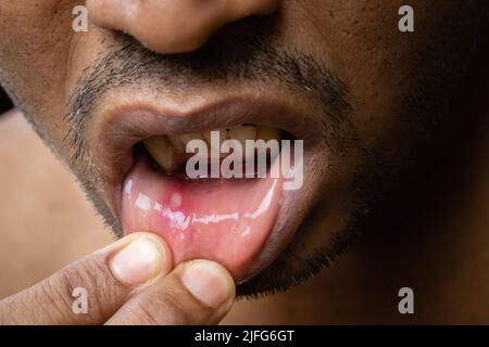 Nahaufnahme eines Mundgeschwürs eines indischen Mannes Stockfoto