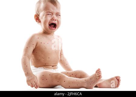 Baby Junge mit Haut durch Blasenausschlag aufgrund von Monkeypox oder Windpocken auf weißem Hintergrund betroffen Stockfoto