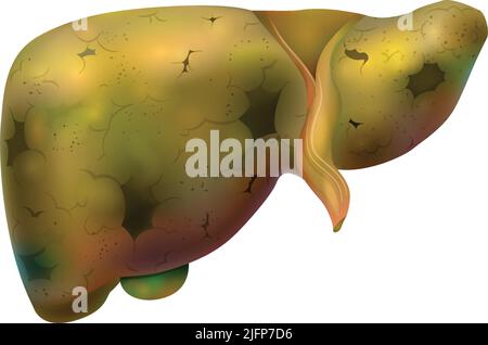 Realistische menschliche innere Organe Leberzusammensetzung mit isoliertem Bild der geschädigten Leber auf leerem Hintergrund Vektorgrafik Stock Vektor