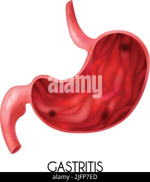 Realistisches medizinisches Bild des menschlichen Magens mit Gastritis auf weißem Hintergrund Vektorgrafik Stock Vektor