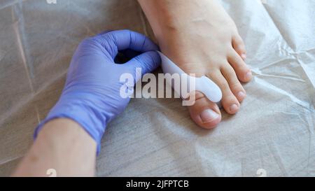 Arzt Orthopäde Anwendung Korsett für Hallux valgus Stockfoto