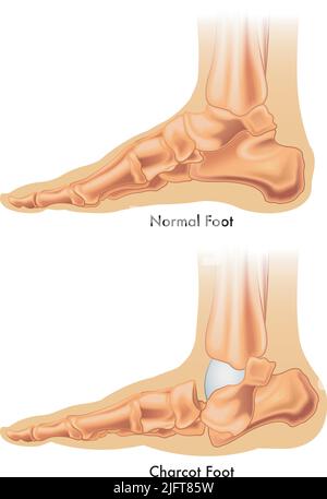 Die medizinische Abbildung zeigt den Unterschied zwischen einem normalen Fuß und einem charcot-Fuß. Stock Vektor