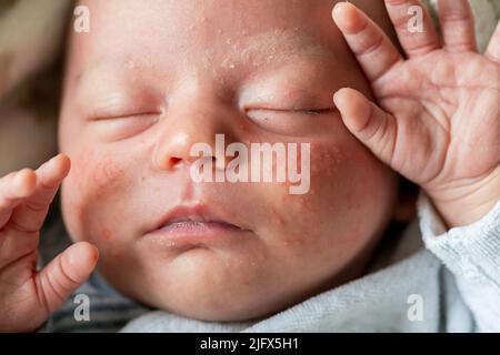 Baby Gesicht Baby mit Milia Akne, engordaderas, Keratin Ansammlungen Stockfoto