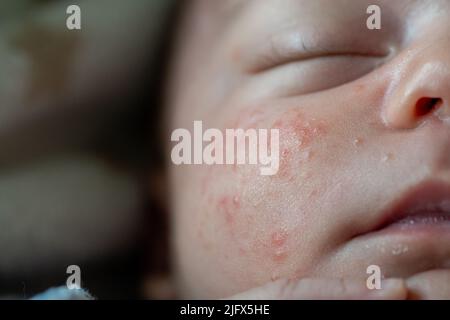 Baby Gesicht Baby mit Milia Akne, engordaderas, Keratin Ansammlungen Stockfoto