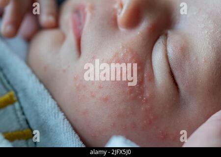 Baby Gesicht Baby mit Milia Akne, engordaderas, Keratin Ansammlungen Stockfoto