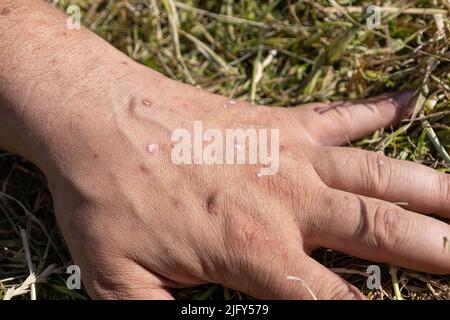 Milder Fall von Psoriasis, Ekzem an den Händen Stockfoto