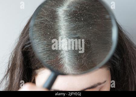 Der Arzt zeigt Nahaufnahme des Scheitelens von brünetten Haaren auf dem Kopf, der mit Schuppen bedeckt ist. Blick durch vergrößertes Glas. Das Konzept der seborrhoischen Derma Stockfoto