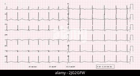 EKG-Beispiel für einen pathologischen 12-Kanal-Rhythmus. Langes QT-Syndrom, echte Untersuchung Stockfoto