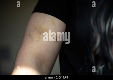 Blutergüsse am Arm des Mannes. Aufprallort. Schulterverletzung. Körperdetails. Fleischige Haut. Stockfoto