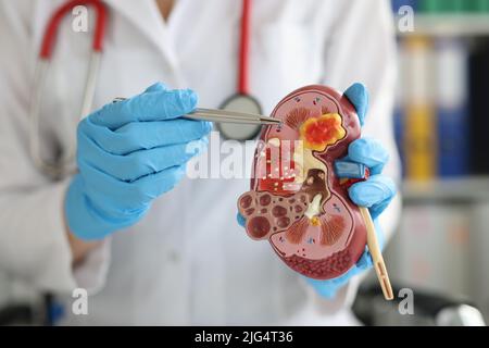 Urologie und Behandlung von Nierenerkrankungen Nahaufnahme Stockfoto