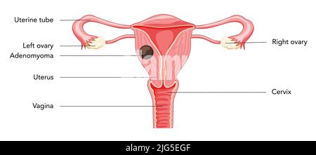 Adenomyom Adenomyose mit Inschriften, menschliche Anatomie weibliche reproduktive Krankensystemorgane. Struktur von Gebärmutter, Gebärmutterhals, Eierstock, Eileiter im lateinischen Text. Frontalansicht Vektordarstellung Stock Vektor