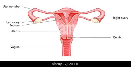 Uterine Septum septate uterus Weibliche Darstellung des Fortpflanzungssystems mit Beschriftungen Text. Menschliche Anatomie innere Organe Schema, Gebärmutterhals, Eierstock, Eileiter flach Vektor medizinische Illustration isoliert Stock Vektor