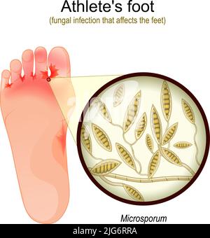 Fußpilz. Pilzinfektion, die die Füße betrifft. Nahaufnahme von Hefe, die Infektionskrankheiten der Haut verursacht. Microsporum. vektorgrafik Stock Vektor