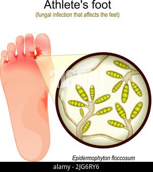 Fußpilz. Pilzinfektion, die die Füße betrifft. Nahaufnahme von Hefe, die Infektionskrankheiten der Haut verursacht. Epidermophyton floccosum. vector illu Stock Vektor