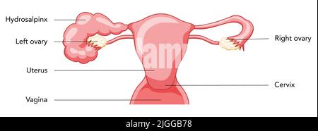 Hydrosalpinx Weibliches Fortpflanzungssystem blockiert Eileiter Uterus mit Beschreibungstext. Menschliche Anatomie innere Organe Vektor medizinische Illustration flache Stil Symbol auf weißem Hintergrund isoliert Stock Vektor