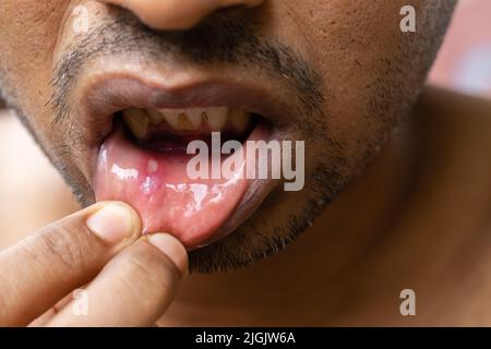 Nahaufnahme eines Mundgeschwürs eines indischen Mannes Stockfoto