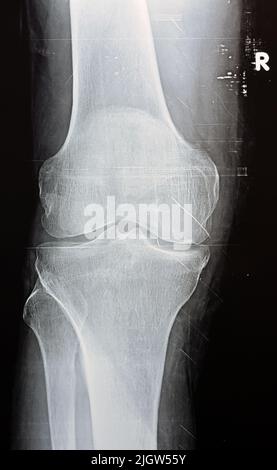 Eine einfache Röntgenaufnahme des rechten Knies zeigt eine scheinbare Gelenkarthritis nach dem Kellgren- und Lawrence-System zur Klassifizierung von Arthrose mit Stockfoto