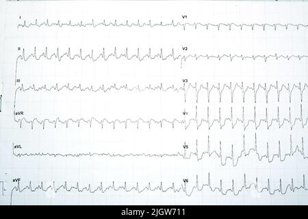 Eine positive Stress-induzierte myokardiale Ischämie mit signifikanten horizontalen ST-Depression-Veränderungen im Stress-EKG-Elektrokardiogramm-Test, Patient war Stockfoto