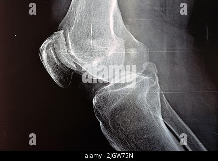 Eine einfache Röntgenaufnahme des rechten Knies zeigt eine scheinbare Gelenkarthritis nach dem Kellgren- und Lawrence-System zur Klassifizierung von Arthrose mit Stockfoto