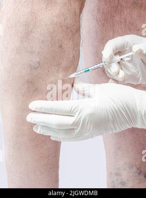 Sklerotherapie an den Beinen eines erwachsenen kaukasischen Mannes. Entfernung von Krampfadern mit Injektion durch einen Arzt in weißen Handschuhen. Atrophierte Venen. Stockfoto