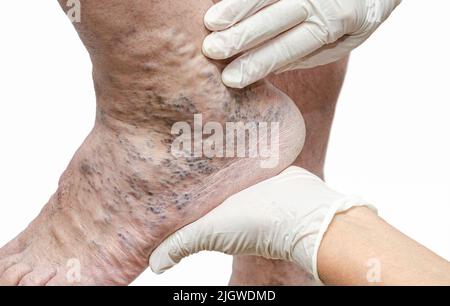 Arzt in weißen Handschuhen, die den Fuß des Mannes halten und auf Krampfadern, tiefe Venenthrombosen und Venenverletzungen am Fuß zeigen. Gesundes Krampfadern. Isol Stockfoto