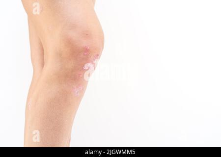 Psoriatische Arthritis mit Psoriasis auf den Knien einer Frau. Entzündliche Arthritis verursacht Schwellungen, Steifheit, Rötung, Schmerzen und Gelenkschäden Stockfoto