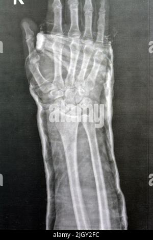 Einfaches rechtes Handgelenkgelenk der Röntgenstrahlung zeigt eine Fraktur des rechten distalen Radius, eine geschlossene Reduktion und eine gegossene Form, einen selektiven Fokus der Röntgenbildgebung, die Fraktur ra zeigt Stockfoto