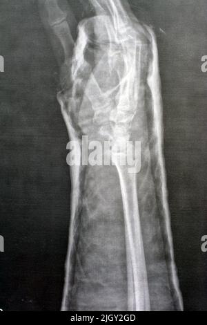 Einfaches rechtes Handgelenkgelenk der Röntgenstrahlung zeigt eine Fraktur des rechten distalen Radius, eine geschlossene Reduktion und eine gegossene Form, einen selektiven Fokus der Röntgenbildgebung, die Fraktur ra zeigt Stockfoto