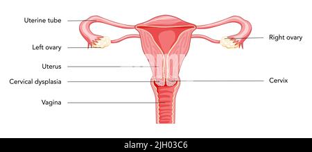 Gebärmutterhalskrebs-Diagramm mit Inschriften in lateinischem Text Weibliches Fortpflanzungssystem Uterus. Vorderansicht im Schnitt. Darstellung der Lage der inneren Organe der menschlichen Anatomie, Symbol für die flache Form der Eierstöpige, Eileiter Stock Vektor