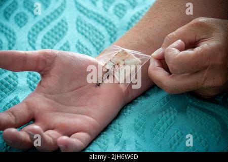 Eine Krankenschwester entfernt einen gepolsterten Verband an Handgelenk und Hand einer Frau. Die Handfläche hat eine Reihe von schwarzen Nylonstichen aus Karpaltunneloperationen. Stockfoto