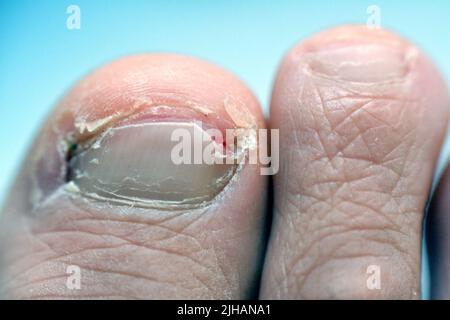 Eingewachsene Zehennagel der großen Zehe des rechten Fußes ist ein häufiger Zustand, in dem die Ecke oder Seite eines Zehennagels wächst in das weiche Fleisch Ergebnis in pa Stockfoto