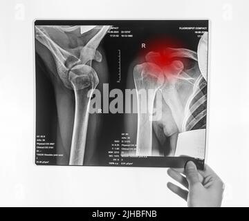 Hand hält Schulter, Schlüsselbein Röntgenbild mit rotem Punkt. Akromion, akromiale Endfraktur. Armverletzung. Gesundheitswesen, medizinische Untersuchung Konzept. Schwarz und Weiß. Hochwertige Fotos Stockfoto