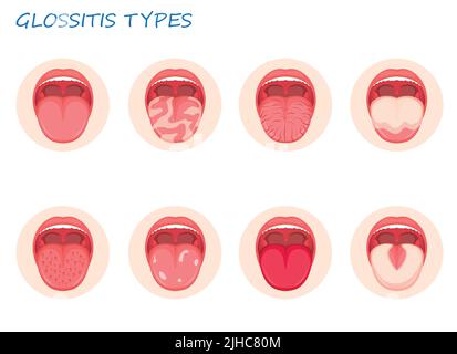 Arten Glossitis. Entzündliche Erkrankung Zunge, Vektor-Illustration Stock Vektor