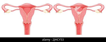 Satz von Asherman-Syndrom Verwachsungen des weiblichen Fortpflanzungssystems von Narbengewebe in der Gebärmutter. Vorderansicht im Schnitt. Krankes und normales Lokalisieren der inneren Organe der menschlichen Anatomie, Gebärmutterhals, flaches Symbol im Eierstock-Stil Stock Vektor